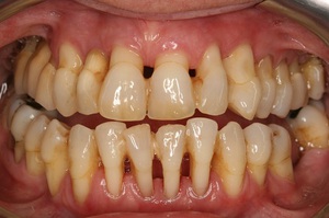 Evde periodontitis iyileşmek için nasıl