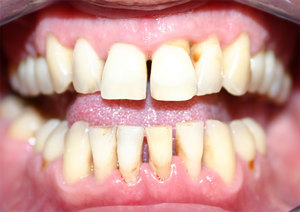 Periodontitis tedavisi için yollar