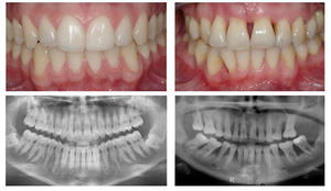 Periodontit tedavisi
