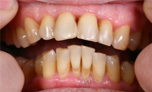 Periodontit tedavisi için ilaçlar