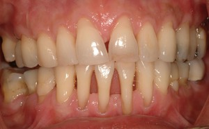 Periodontitis neden oluşur?