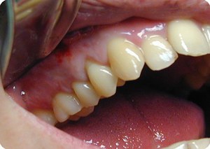 Periodontit belirtileri