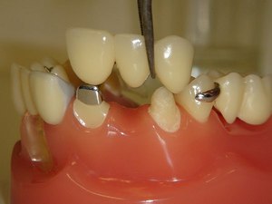 Dental köprülerin karakteristik tanımları