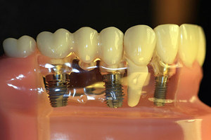 Dental implantların özellikleri ve kurulum prosedürünün özellikleri