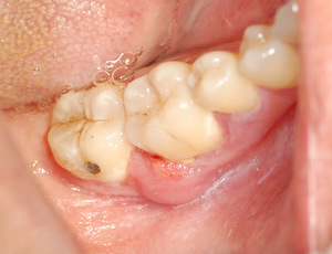 Periodontal cep - bu nedir