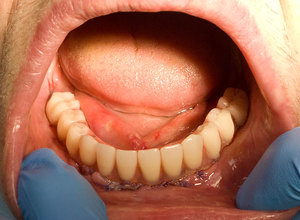 Diş bazal implant tiplerinin özellikleri