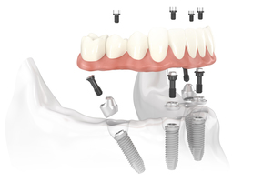 Abantment nedir?