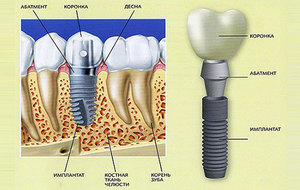 Diş implantları