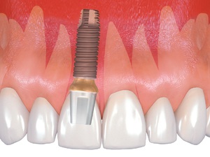 Diş implantasyonu seçeneği