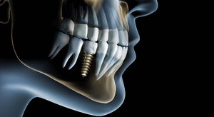 Dental implantların dezavantajları