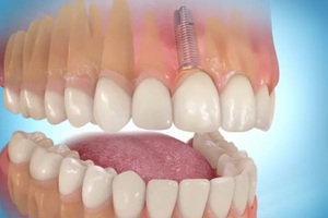 Hastalar implantlar hakkında ne söylüyor