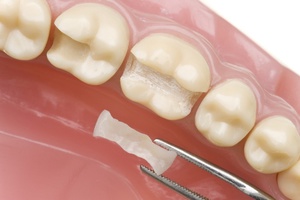 Mikroprosthetics, bir diş parçasını geri yüklemenizi sağlar.