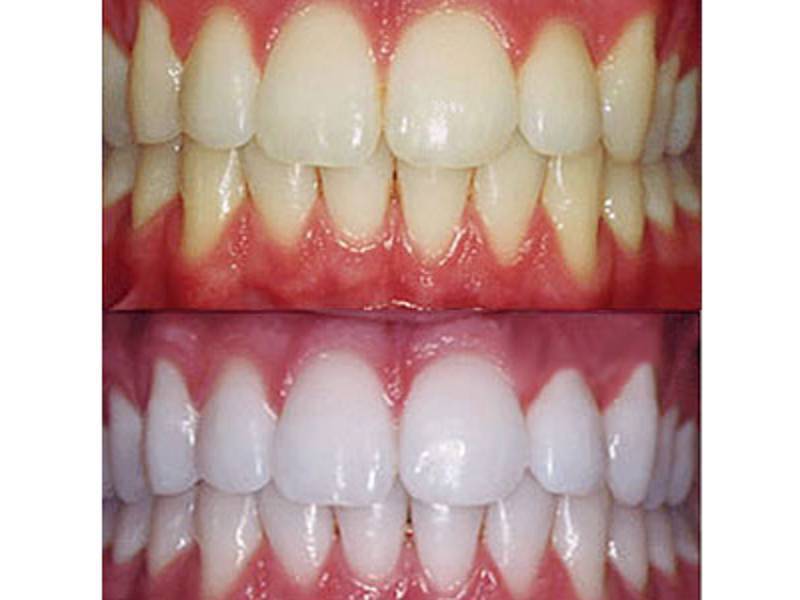 Önce ve sonra diş tipleri Teşekkürler avizeler aydınlandı gülümseme