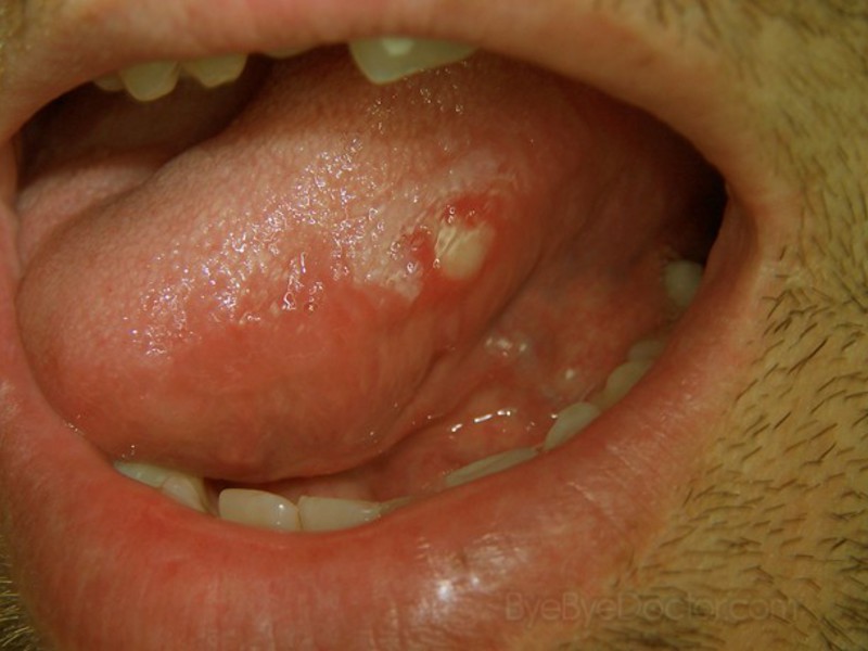 Ağız ülseri nedir? Ağız ülseri nedenleri