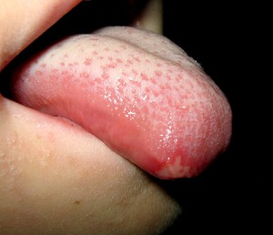Oral mukoza tedavisinde ilaçlar