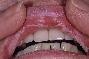 Oral mukoza hastalığı ile ne yapılmalı