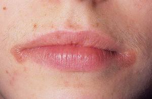Dudaklarda cheilitis nelerdir