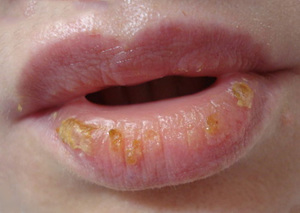 Hastalık tipi cheilitis