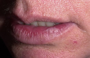 Ne ilaçları cheilitis tedavi