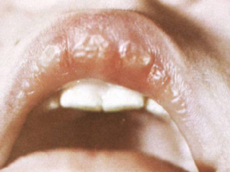 Dudak hastalığı Cheilitis dudaklarına nasıl yardım edilir