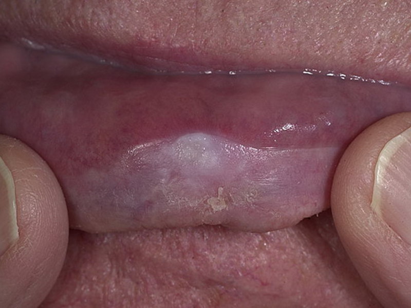 Dudak hastalığı Halk ilaçları ne cheilitis ile yardımcı olur