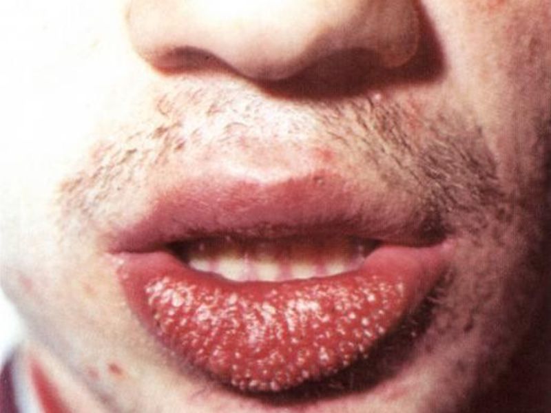 Yetişkinlerde dudaklarda Heylita Erişkinlerde Cheilitis
