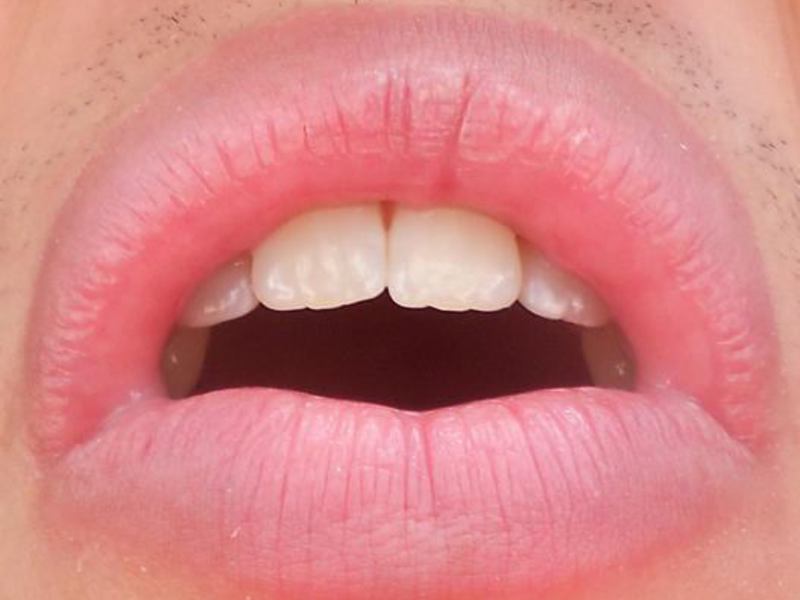 Dudak hastalığı Cheilitis ile nasıl baş edilir?