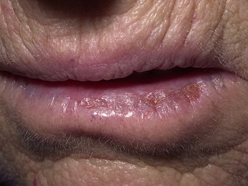 Cheilitis için öneriler Dudakları lekelemek için ne önerilir?