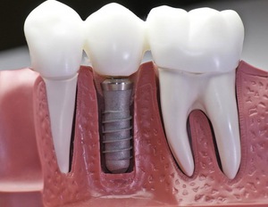 Diş üzerinde implant nasıl yapılır