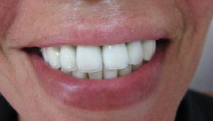 Hangi tip dental implantlar vardır?