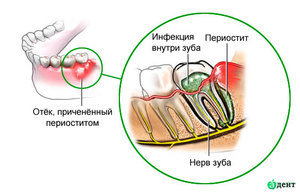 Dişin periostit Periostitis diş fotoğrafı