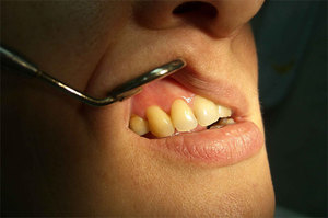 Odontojenik periostitis fotoğraf